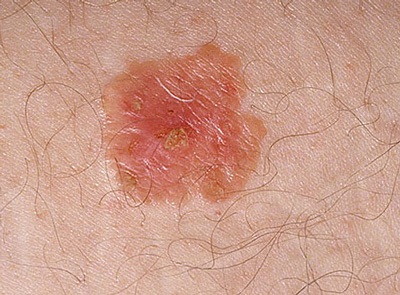 Những dấu hiệu của ung thư da - 17