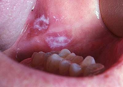 Top những vấn đề ở miệng - 4 Top những vấn đề ở miệng - 4