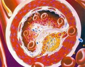 5 cách hạn chế cholesterol - 1