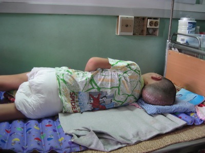 Thăm lại cậu bé mắc bệnh u não Vũ Văn Thơ - 2 Thăm lại cậu bé mắc bệnh u não Vũ Văn Thơ - 2