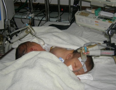 Hai bé gái sinh đôi dính ngực nằm ngược đầu nhau - 1