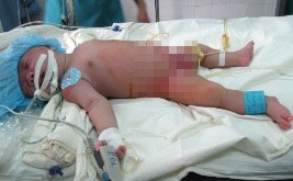 Em bé 4 chân đã được tách bỏ “chân thừa” - 2