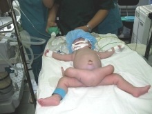 Em bé 4 chân đã được tách bỏ “chân thừa” - 1