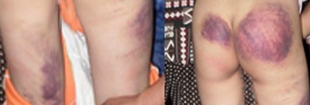 Bé gái 11 tuổi bị đánh đập tàn ác - 1