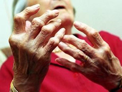 Viêm khớp dạng thấp - Bệnh không chỉ ở khớp - 1 Viêm khớp dạng thấp - Bệnh không chỉ ở khớp - 1