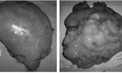 Cắt khối u mỡ hiếm gặp nặng 1,5kg  - 1