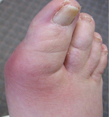 Bị gout hay viêm khớp? - 1 Bị gout hay viêm khớp? - 1