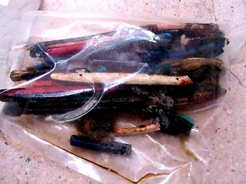 Nuốt 13 bàn chải đánh răng trong 2 năm  - 2