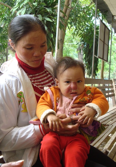 Cô bé bị u máu vùng mặt  - 1