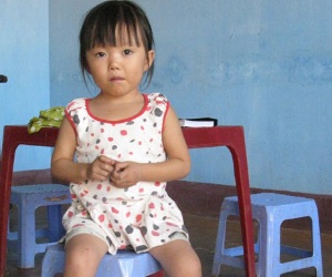 Bệnh tình nguy hiểm của bé gái có trái tim bên phải - 1 Bệnh tình nguy hiểm của bé gái có trái tim bên phải - 1