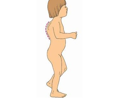Phát hiện sớm bệnh gù lưng ở trẻ em  - 1