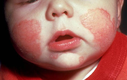Chăm sóc trẻ bị eczema - 1