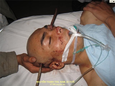 Cứu sống bệnh nhân bị thanh sắt đâm xuyên não - 1