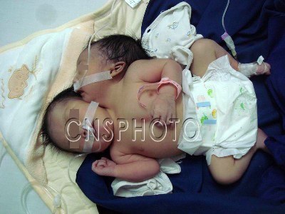 Một em bé hai đầu bị bỏ rơi - 1 Một em bé hai đầu bị bỏ rơi - 1