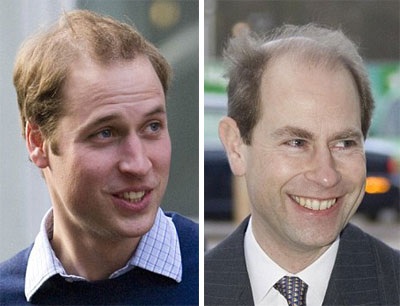 Hoàng tử Anh bị hói đầu di truyền - 1