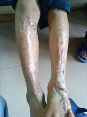 Nỗi đau của cậu bé bị anh họ thiêu đốt - 2