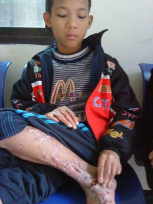 Nỗi đau của cậu bé bị anh họ thiêu đốt - 1