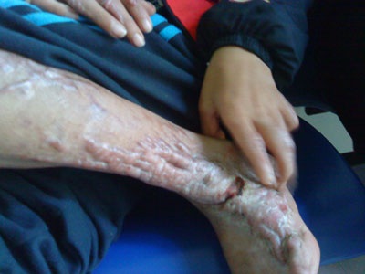 Nỗi đau của cậu bé bị anh họ thiêu đốt - 3