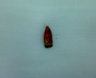 Bị bắn thủng trán, mất não trong một tai nạn hy hữu - 1 Bị bắn thủng trán, mất não trong một tai nạn hy hữu - 1