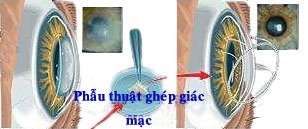Giải pháp mang lại ánh sáng cho những bệnh nhân cần ghép giác mạc - 1 Giải pháp mang lại ánh sáng cho những bệnh nhân cần ghép giác mạc - 1