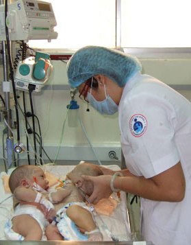 Tách thành công cặp song sinh 16 ngày tuổi dính gan - 1 Tách thành công cặp song sinh 16 ngày tuổi dính gan - 1