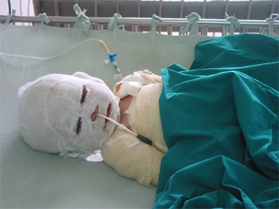 Ngằn ngặt tiếng khóc của bé 3 tuổi bị bỏng toàn thân - 1 Ngằn ngặt tiếng khóc của bé 3 tuổi bị bỏng toàn thân - 1