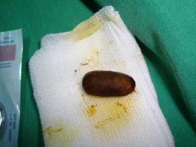 Cấp cứu thành công bệnh nhân bị tắc mật do sỏi ống mật chủ - 1