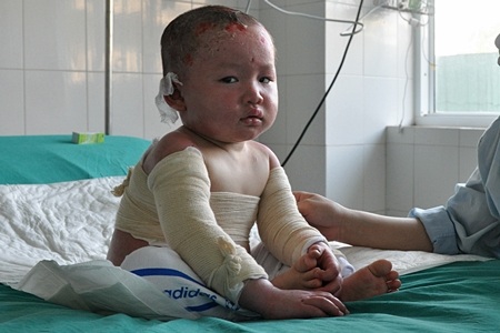 Bé 3 tuổi bỏng nước sôi toàn thân xuất viện - 1