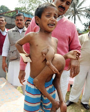 Cậu bé 4 chân 3 tay - 1