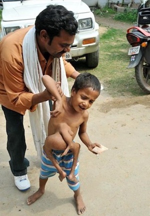 Cậu bé 4 chân 3 tay - 2