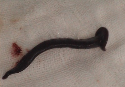 Gắp con đỉa dài 15cm ra khỏi phổi cô gái trẻ - 2