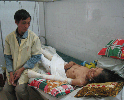 Nhiều người bị bỏng do sưởi ấm - 1  Nhiều người bị bỏng do sưởi ấm - 1