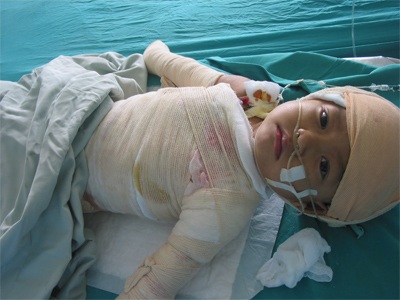 Đông đảo bạn đọc giúp đỡ bé 3 tuổi bị bỏng vôi toàn thân - 4 Đông đảo bạn đọc giúp đỡ bé 3 tuổi bị bỏng vôi toàn thân - 4