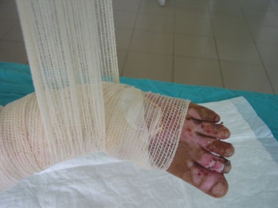 Bé 3 tuổi bỏng vôi toàn thân lên bàn mổ lần thứ 6 - 3