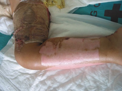 Bé 3 tuổi bỏng vôi toàn thân lên bàn mổ lần thứ 6 - 1