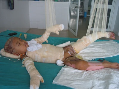 Bé 3 tuổi bỏng vôi toàn thân lên bàn mổ lần thứ 6 - 4