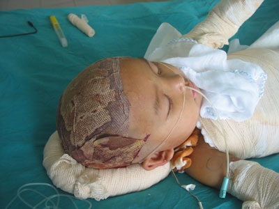 Bé 3 tuổi bỏng vôi toàn thân lên bàn mổ lần thứ 6 - 2