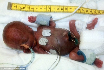 Bé sơ sinh nặng 3 lạng vẫn sống - 1