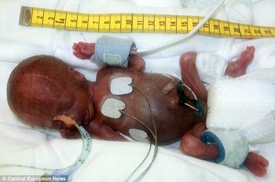 Nuôi dưỡng thành công em bé chào đời lúc 25 tuần tuổi - 1 Nuôi dưỡng thành công em bé chào đời lúc 25 tuần tuổi - 1