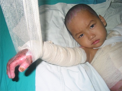 Bé bỏng vôi cần thêm ít nhất một tháng điều trị phục hồi chức năng - 3 Bé bỏng vôi cần thêm ít nhất một tháng điều trị phục hồi chức năng - 3