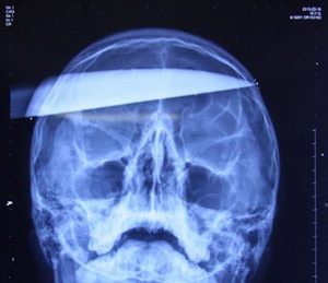 Dao dài 20cm xuyên qua đầu vẫn sống - 1