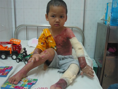 Bé Nguyên bỏng vôi vẫn phải điều trị di chứng  - 1