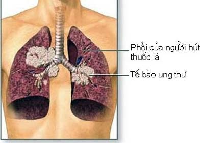 Xét nghiệm cảnh báo ung thư phổi ở người hút thuốc - 1 Xét nghiệm cảnh báo ung thư phổi ở người hút thuốc - 1