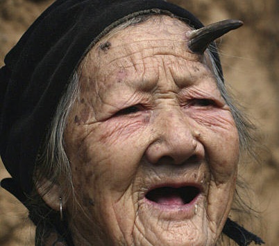 Sừng trên trán cụ bà 102 tuổi dài gấp đôi sau 1 năm - 3