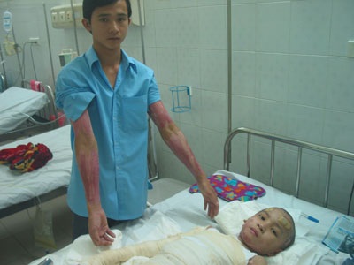 Cậu bé bị bỏng xăng đã qua cơn nguy kịch - 1 Cậu bé bị bỏng xăng đã qua cơn nguy kịch - 1