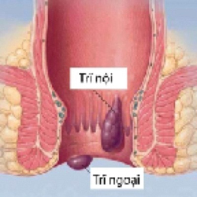 Bạn bị trĩ? Có cách đấy - 2 Bạn bị trĩ? Có cách đấy - 2