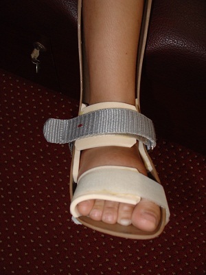 Bàn chân lệch có nguy hiểm? - 2