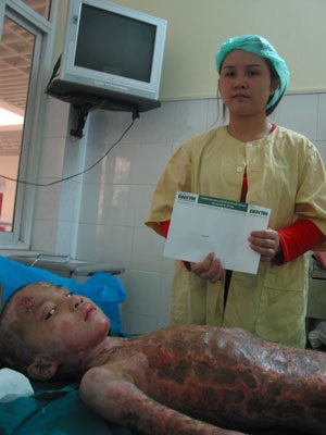Kinh hoàng trước di chứng của cậu bé bị bỏng xăng - 2 Kinh hoàng trước di chứng của cậu bé bị bỏng xăng - 2