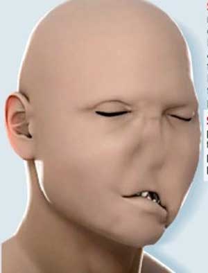 Các bước trong ca phẫu thuật ghép toàn bộ gương mặt - 1 Các bước trong ca phẫu thuật ghép toàn bộ gương mặt - 1