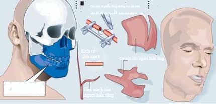 Các bước trong ca phẫu thuật ghép toàn bộ gương mặt - 2 Các bước trong ca phẫu thuật ghép toàn bộ gương mặt - 2